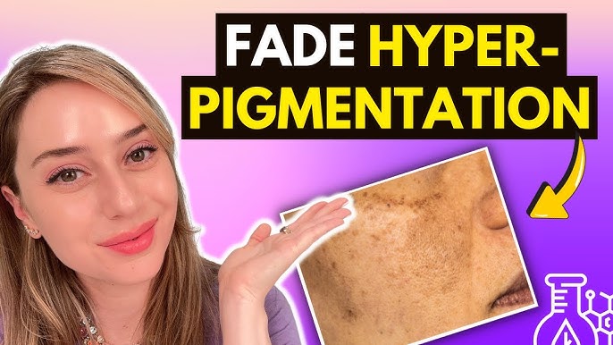 Fading Hyperpigmentation